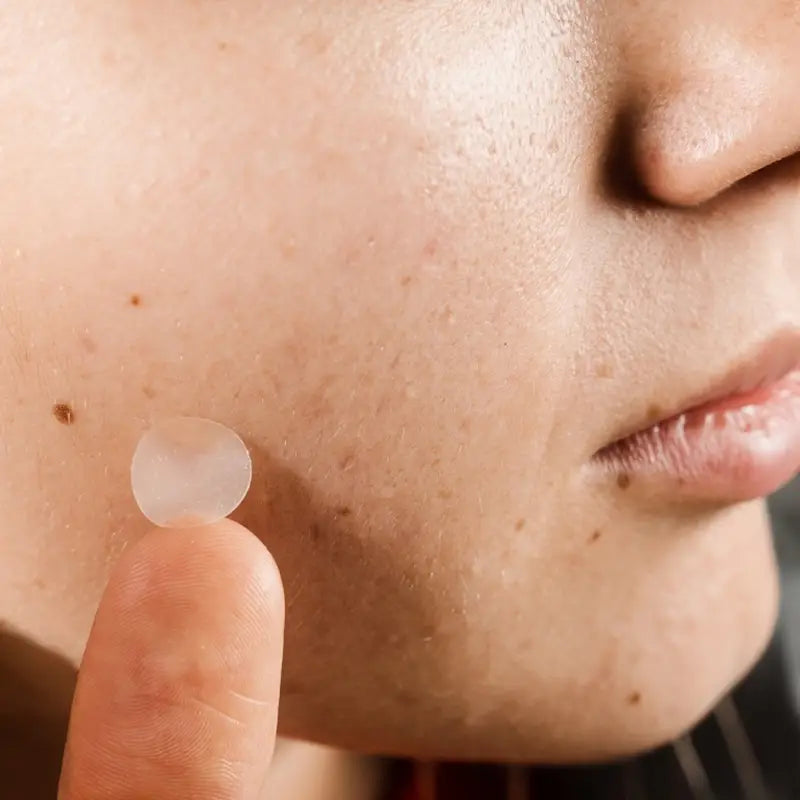 ملصقات حب الشباب – patches anti acne