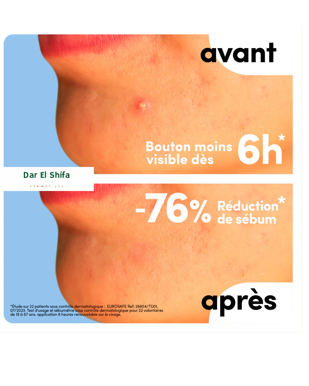 ملصقات حب الشباب – patches anti acne