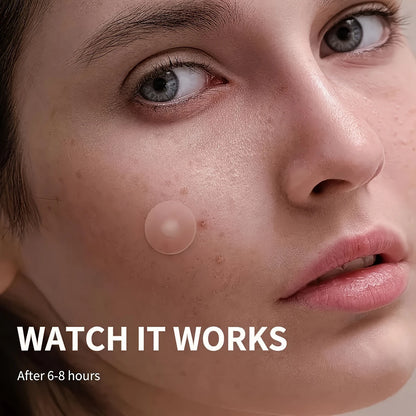 ملصقات حب الشباب – patches anti acne
